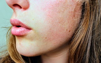 正规借卵代生：【宝宝红JJ怎么护理用什么药膏】